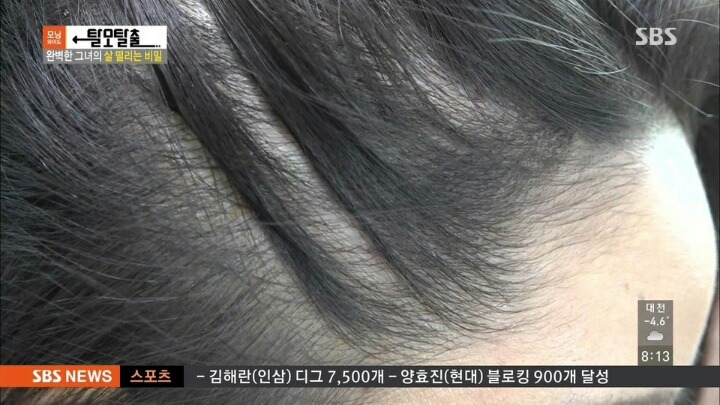 탈모가 고민인 여성 모델 | 인스티즈