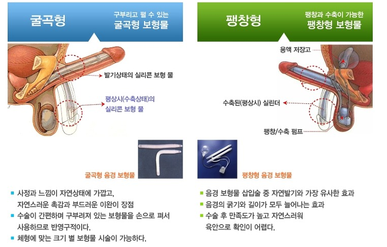 아래글에 여성시술 보고 놀라는 분들 ㅋㅋㅋ남자도 깜짝 놀랄 시술있어요... | 인스티즈