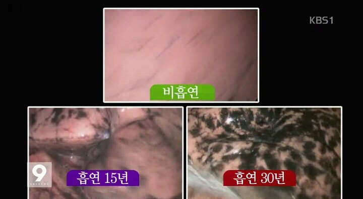 흡연자들의 폐 내시경.jpg (사진주의) | 인스티즈